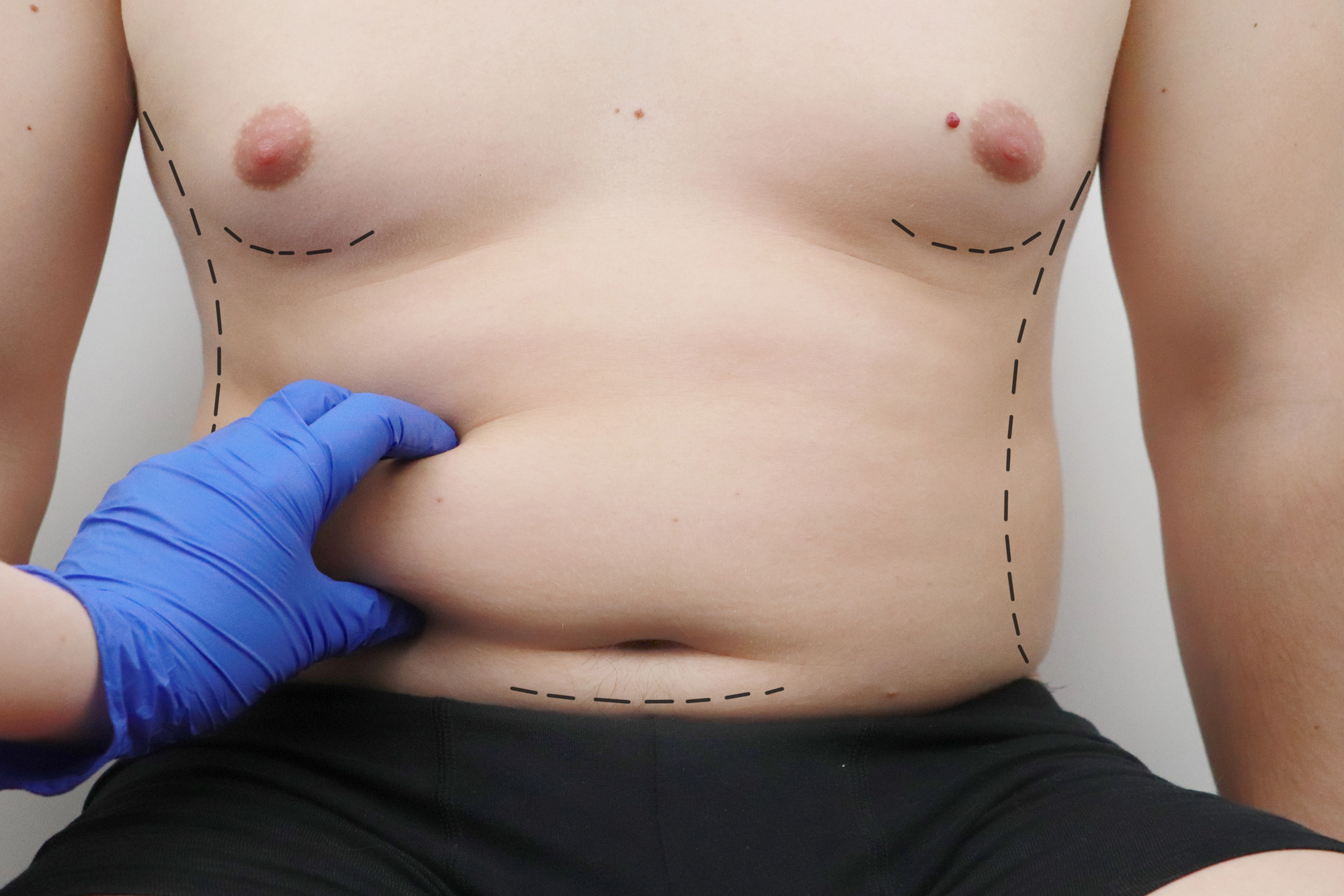 Fettabsaugung beim Mann – Behandlung bei Dr. Heitland in München