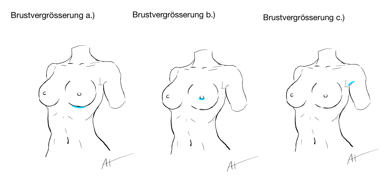 Skizze: Zugänge für Implantate bei der Brustvergrößerung – Unterbrustfalte, Brustwarzenhof, Achselhöhle